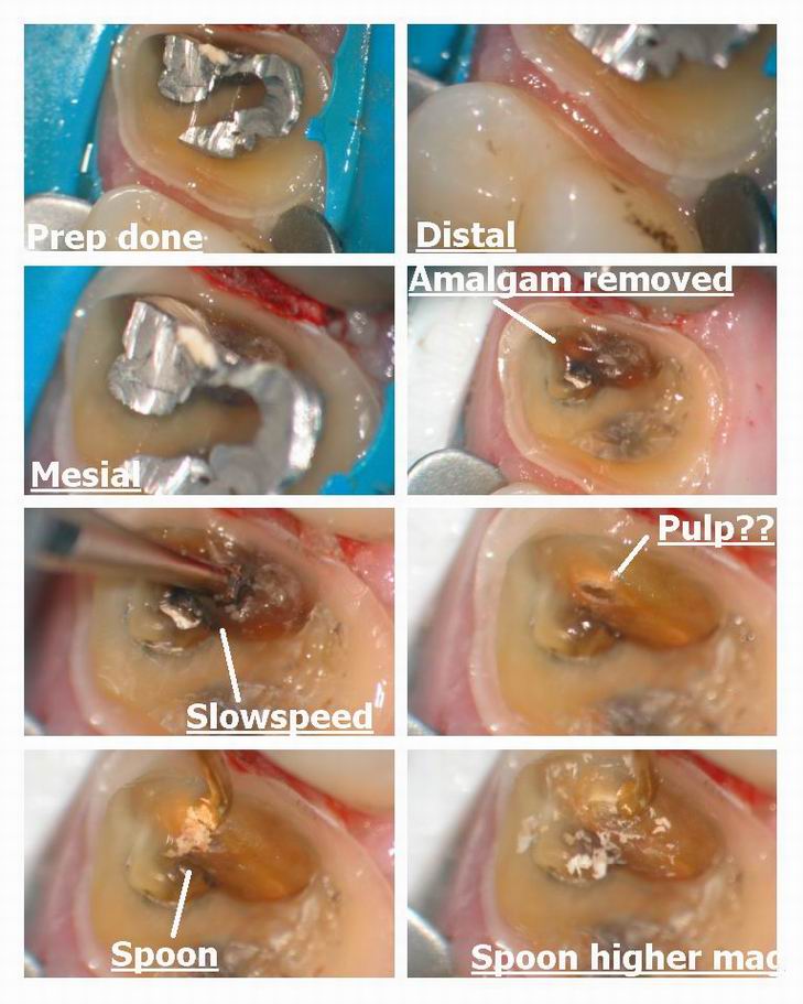 Resize of Pg 2 of crown prep.jpg